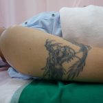 刺青を消したい　二の腕
