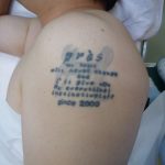 刺青を消したい　二の腕５
