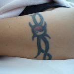 刺青を消したい　二の腕２