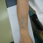 刺青を消したい　二の腕７