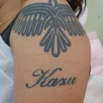 刺青を消したい　二の腕６