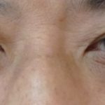 目の下の脂肪取り、タルミ取り　どちらがいいの？２