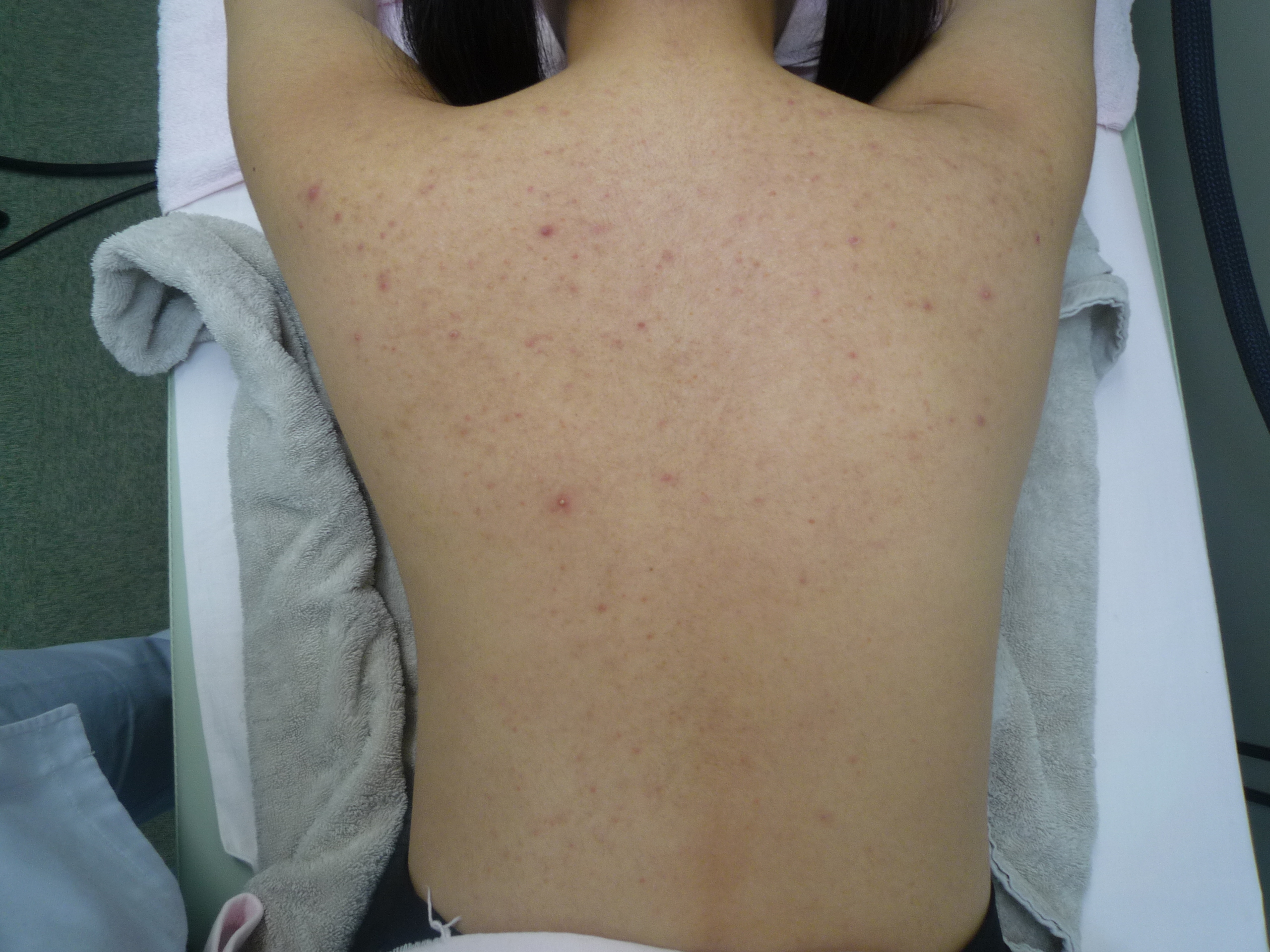 背中のニキビ治療 横浜で働く美容外科院長の美容整形ここだけの話ブログ