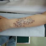 刺青を消したい