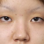 目頭切開　複数の手術の相乗効果　３