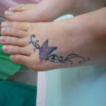 刺青を消したい　足の甲２