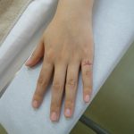 刺青を消したい　指