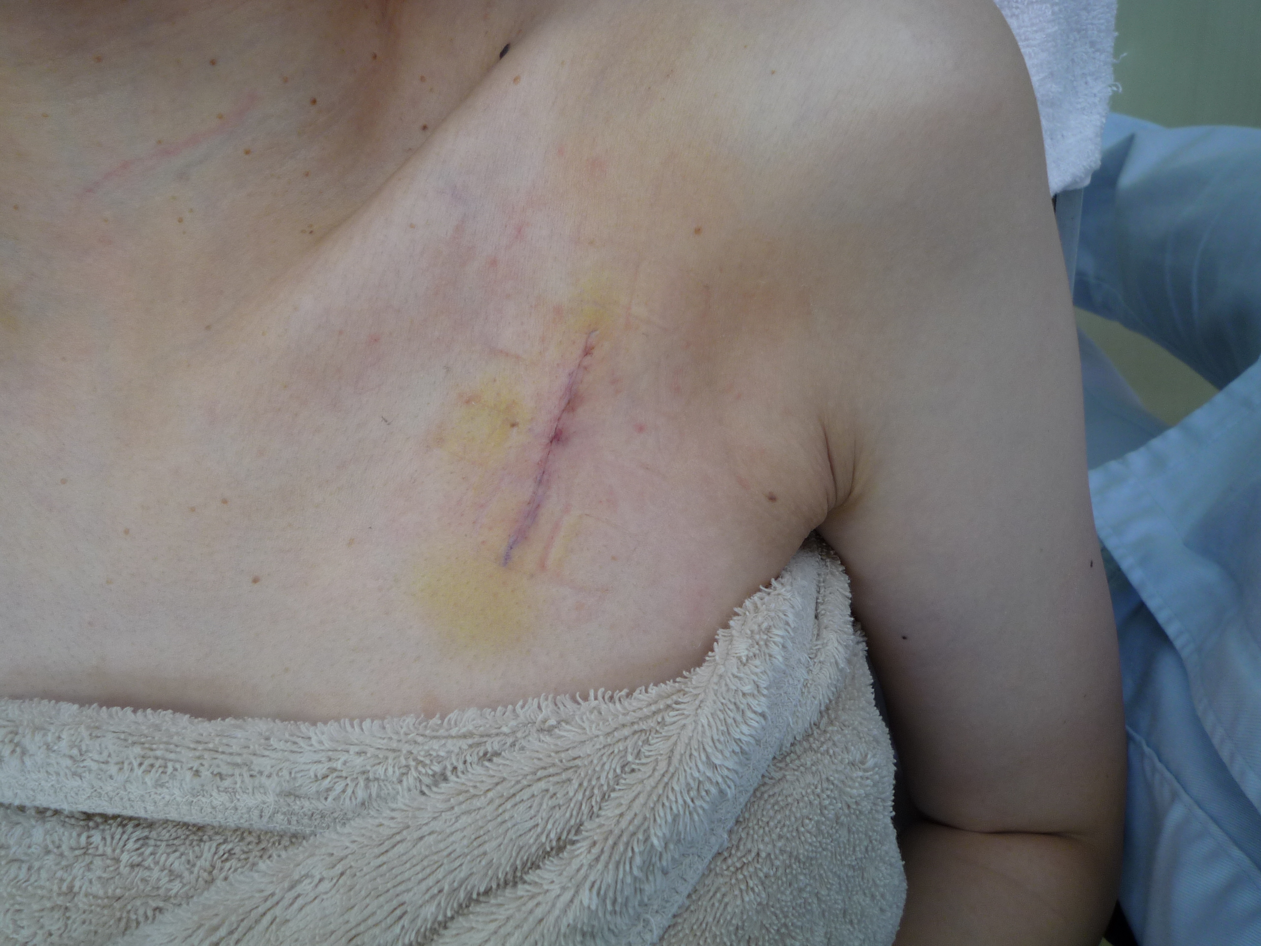 刺青を消したい 胸 画像あり 横浜で働く美容外科院長の美容整形ここだけの話ブログ