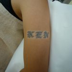 刺青を消したい