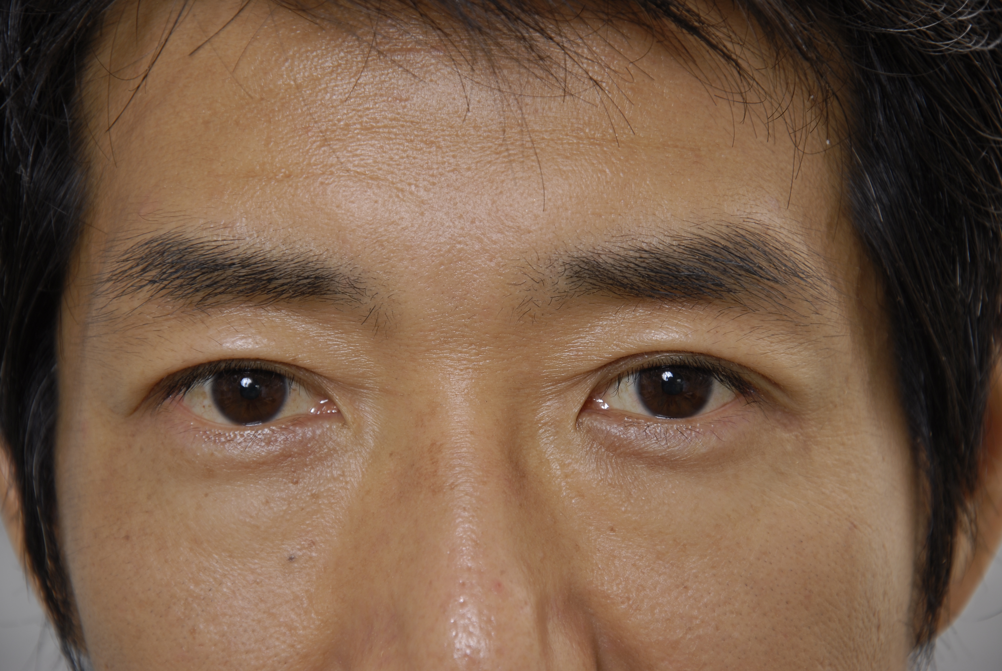 二重まぶた 埋没法の効果 画像あり 横浜で働く美容外科院長の美容整形ここだけの話ブログ