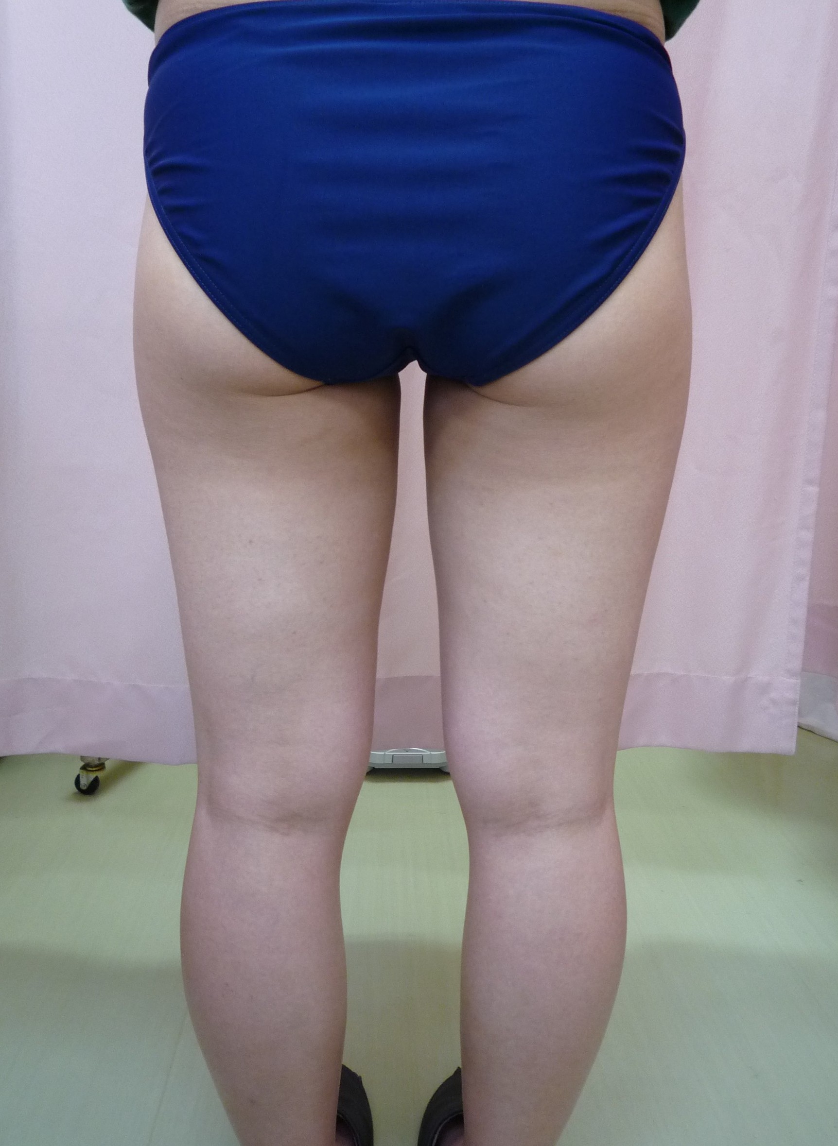 q a13 q 脚を細くしたい 脂肪吸引と脂肪溶解注射 どちらがいいの 画像あり 横浜で働く美容外科院長の美容整形ここだけの話ブログ q a13 q 脚を細くしたい 脂肪吸引と脂肪溶解注射 どちらがいいの 画像あり 横浜で働く美容外科院長の美容整形ここだけの話ブログ