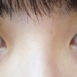 Ｑ＆Ａ１４　Ｑ：埋没法。２点留め、３点留め、４点留め、どれがいいの？　（画像あり）