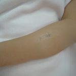 刺青を消したい　手首、肘下特集３　（画像あり）