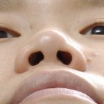 Ｑ＆Ａ１６　Ｑ：小鼻縮小は元に戻ることがあるって本当ですか？　（画像あり）