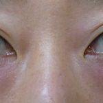 目の下のくまを取りたい（３０代）　（画像あり）