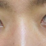 涙袋形成はいくらかかる？値段、料金と実際の症例写真をご紹介！