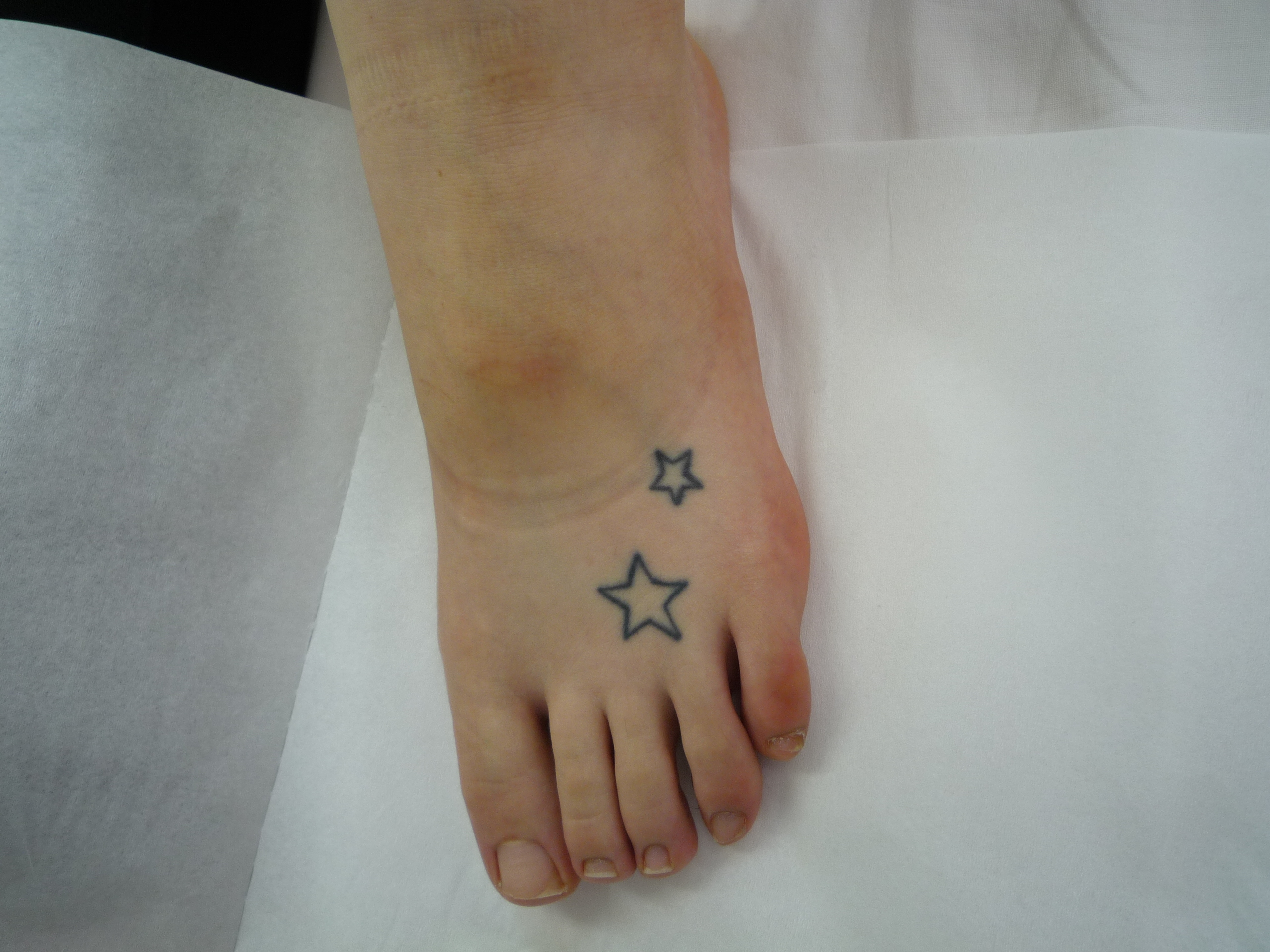 刺青を消したい 足首 足の甲 画像あり 横浜で働く美容外科院長の美容整形ここだけの話ブログ
