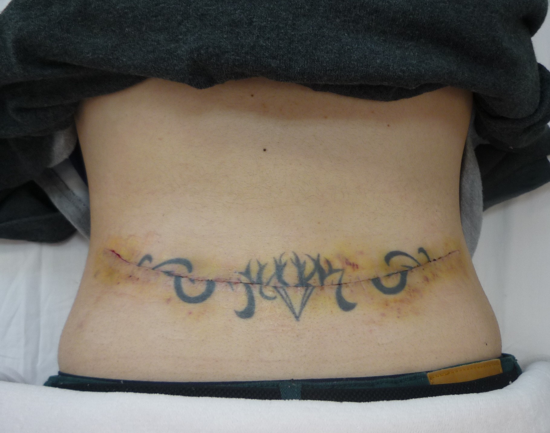 腰の入れ墨 タトゥー の治療期間は 経過をご紹介 症例写真あり 横浜で働く美容外科院長の美容整形ここだけの話ブログ