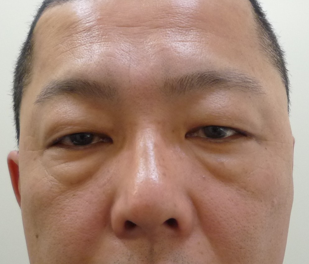 目の下のタルミ取りでお顔全体の印象を変える ４０代 ５０代男性の症例 画像あり 横浜で働く美容外科院長の美容整形ここだけの話ブログ
