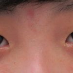 埋没法。やっぱり自然な末広型がいい。　（画像あり）