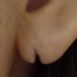ピアスで耳たぶが裂けた　（画像あり）