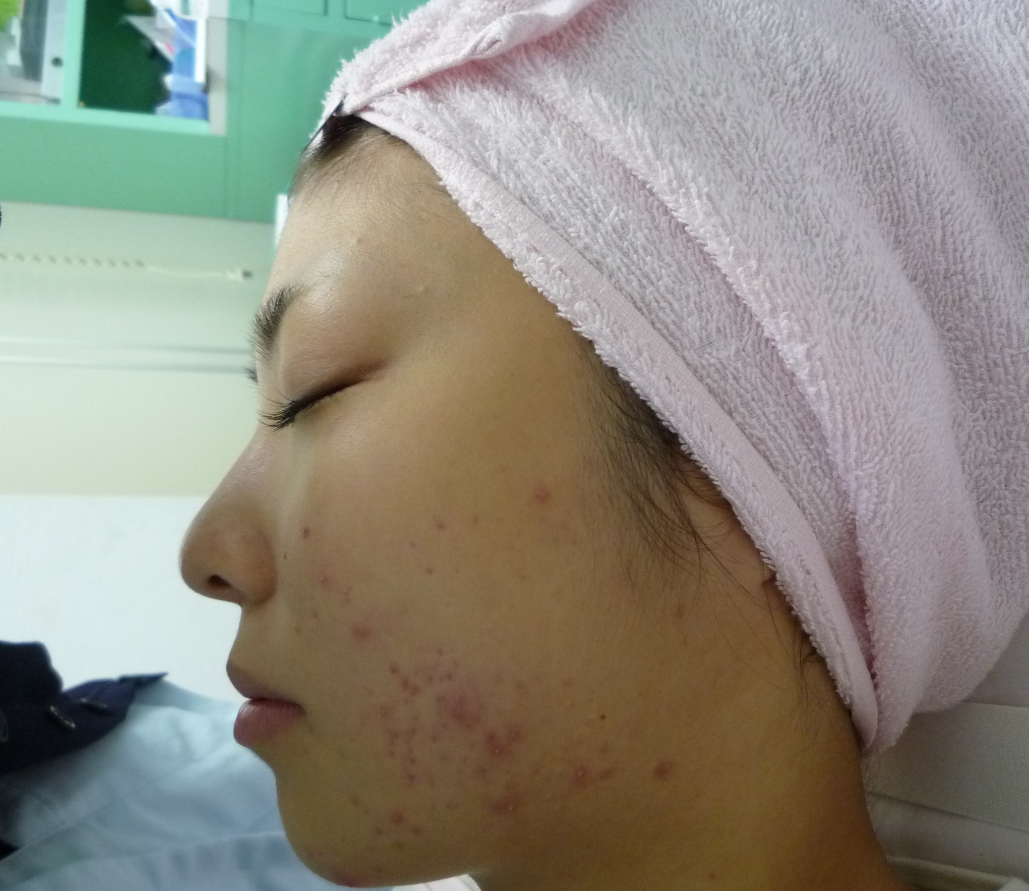 なかなか治らない大人のニキビ ２ 画像あり 横浜で働く美容外科院長の美容整形ここだけの話ブログ