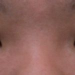 平行型二重　全切開法＋目頭切開　２０代　（画像あり）