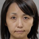 フェイスリフトで自然に綺麗に若返る　４　（３０代）　（画像あり）