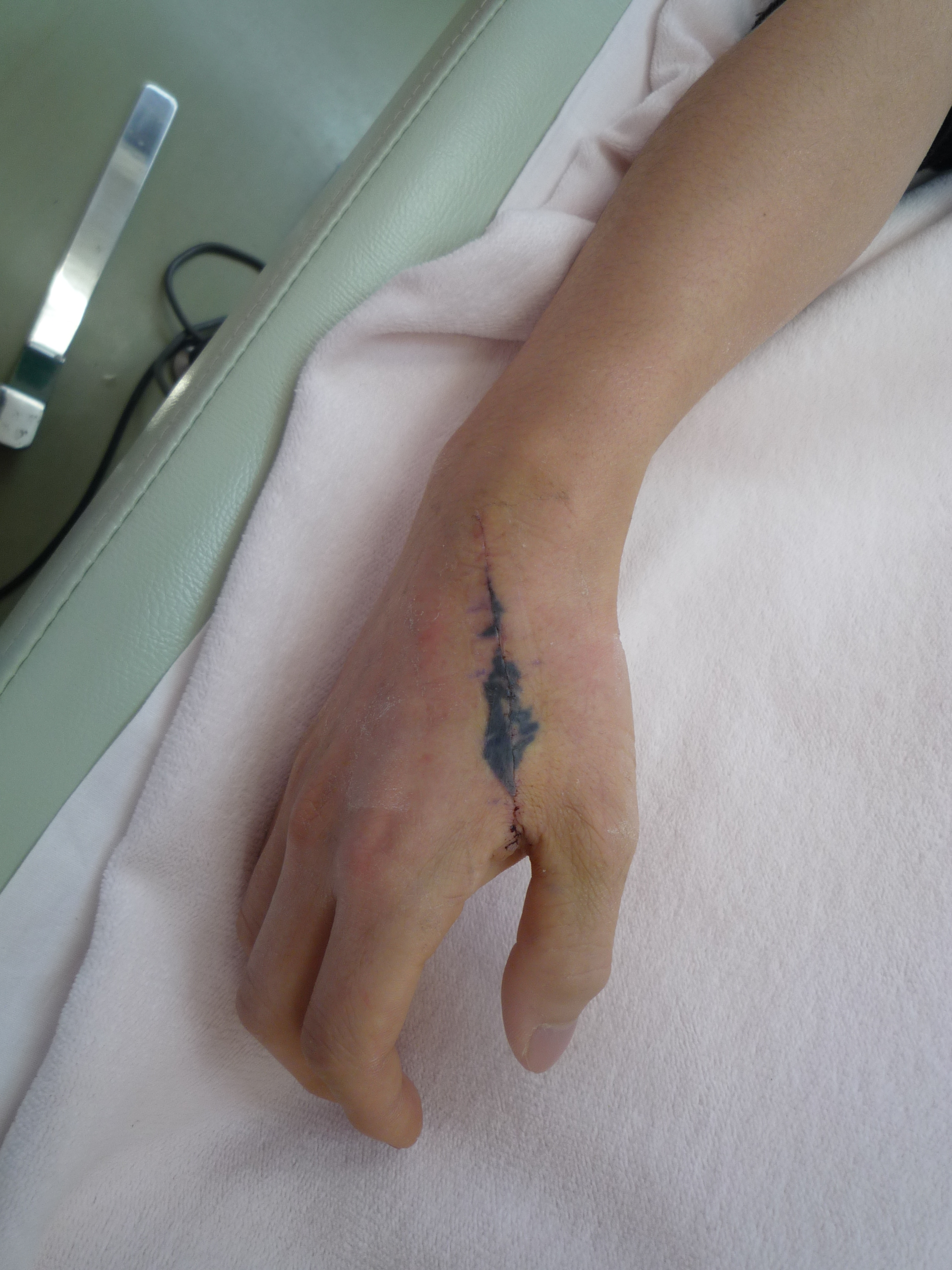刺青を消したい 手周辺 １ （画像あり） | 横浜で働く美容外科院長の ..., 画像サイズ:1920x2560