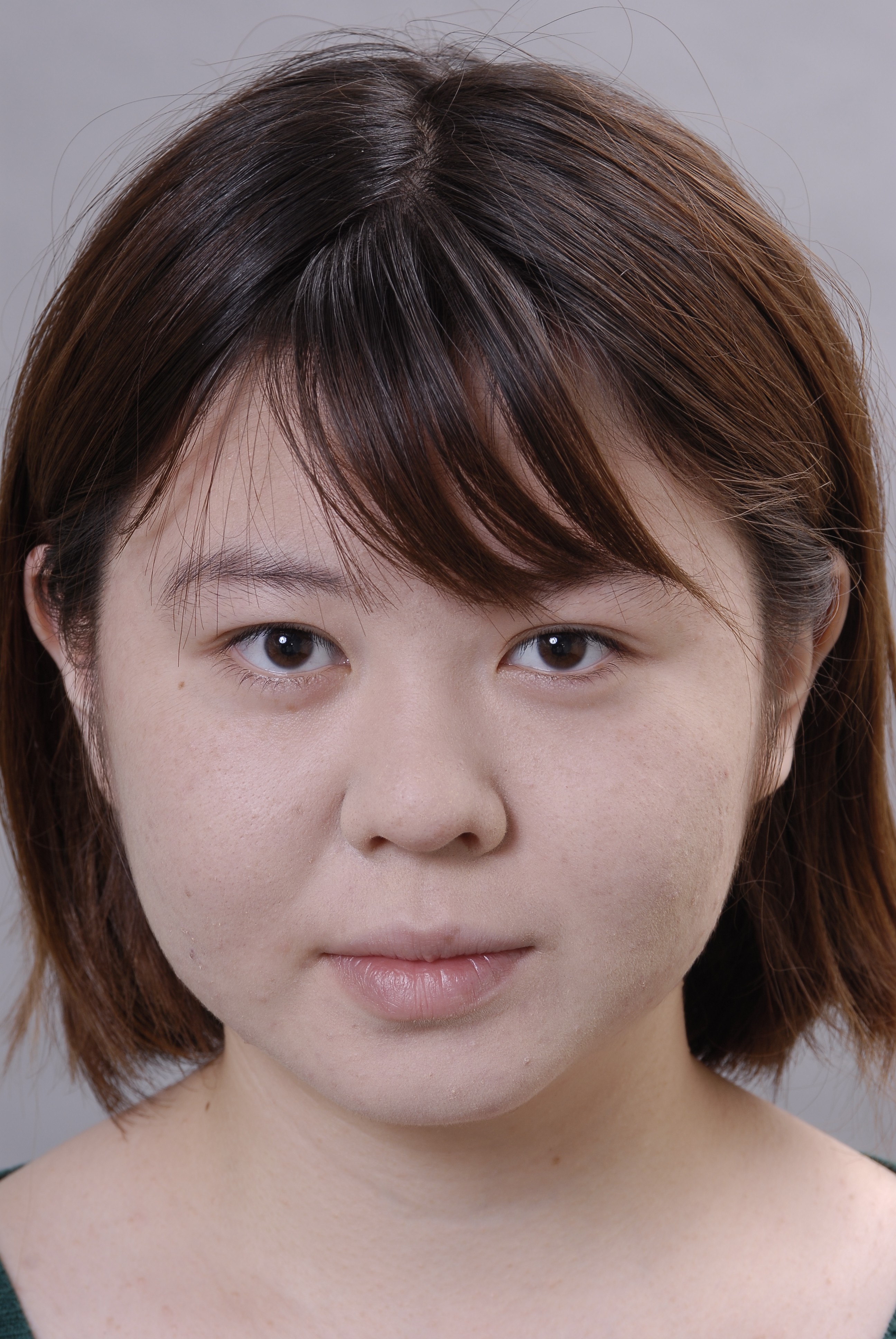 頬の脂肪 メーラーファット が脂肪吸引で劇的変化 症例写真あり 横浜で働く美容外科院長の美容整形ここだけの話ブログ