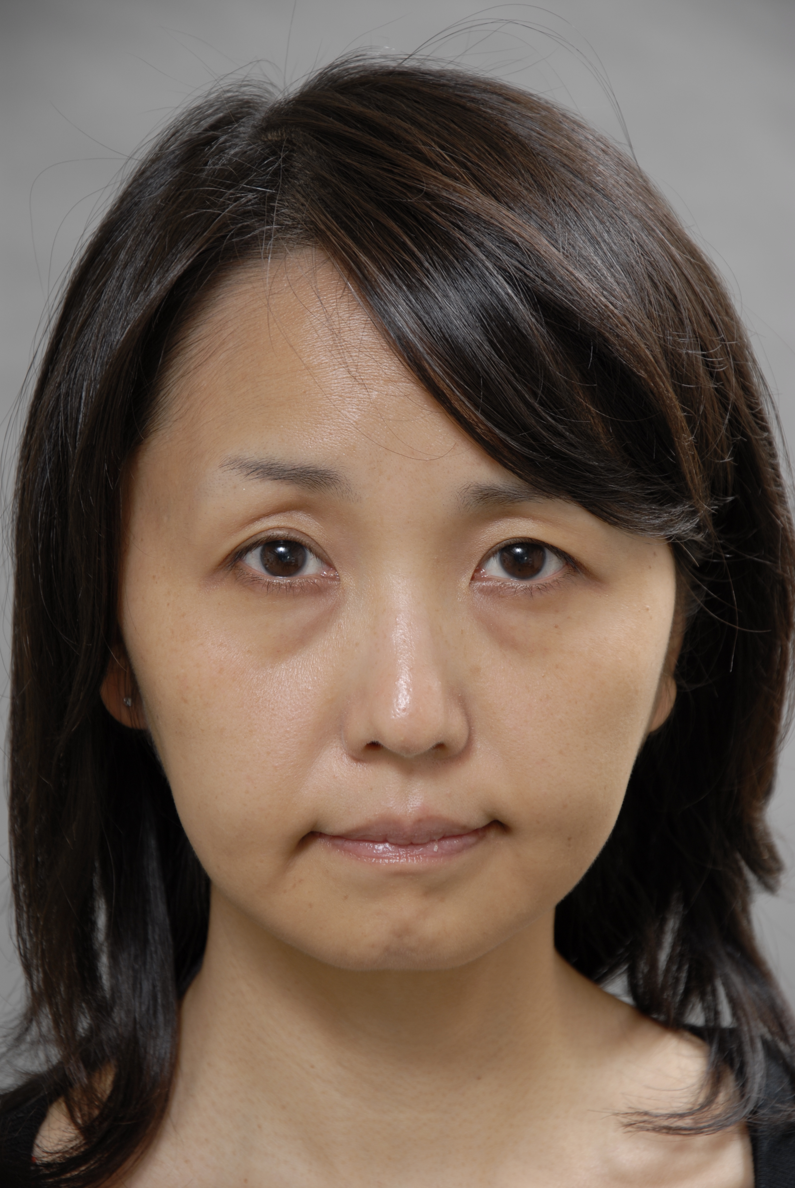 フェイスリフトで失敗しないために 画像あり 横浜で働く美容外科院長の美容整形ここだけの話ブログ