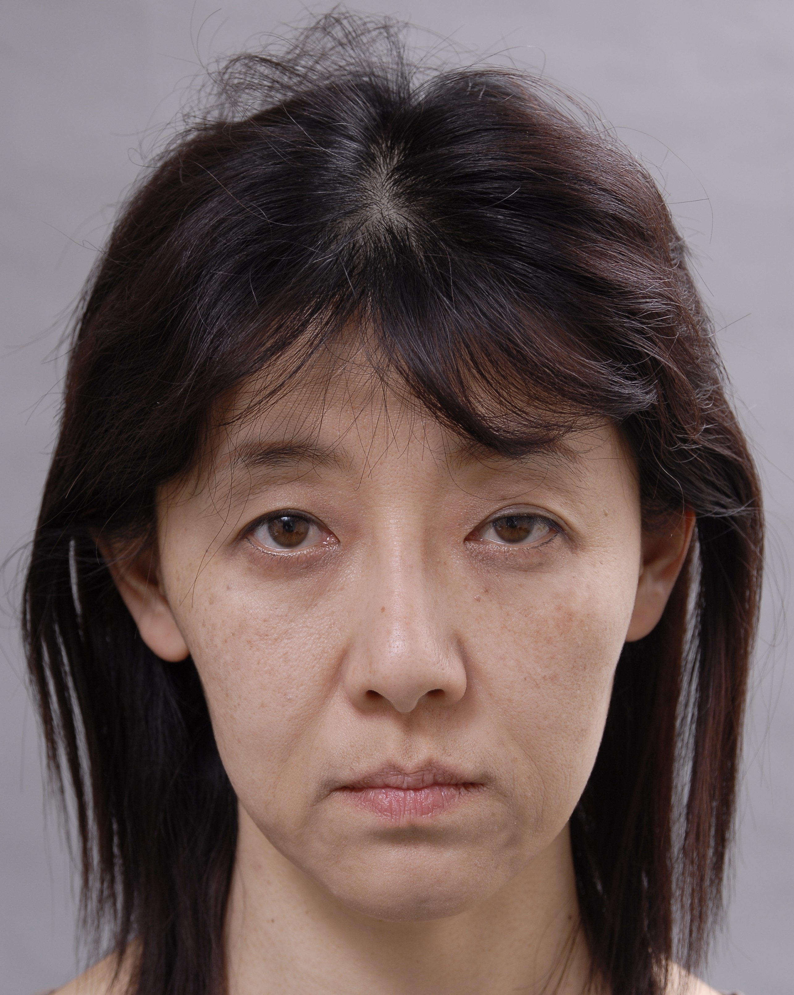 フェイスリフトで失敗しないために 画像あり 横浜で働く美容外科院長の美容整形ここだけの話ブログ フェイスリフトで失敗しないために 画像あり 横浜で働く美容外科院長の美容整形ここだけの話ブログ
