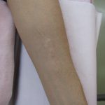 刺青を取りたい　やけど跡　（画像あり）