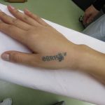 刺青を取りたい　手・指　（画像あり）