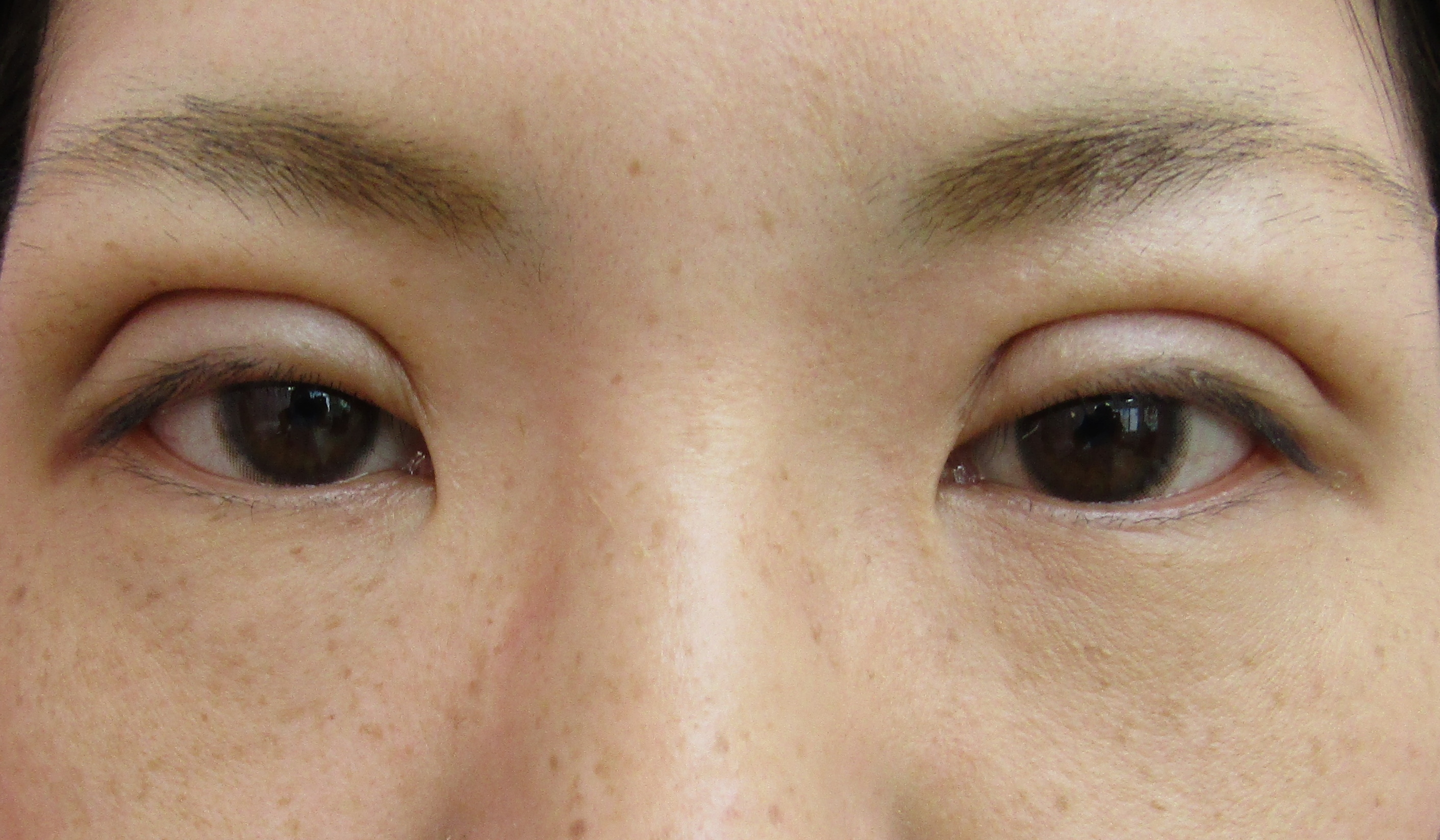 埋没法 微妙な左右差は修正可能か 画像あり 横浜で働く美容外科院長の美容整形ここだけの話ブログ 埋没法 微妙な左右差は修正可能か 画像あり 横浜で働く美容外科院長の美容整形ここだけの話ブログ