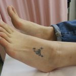刺青を取りたい　足の甲　（画像あり）