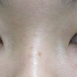 平行型二重は整形でばれずにきれいにできる！術後の経過写真を公開