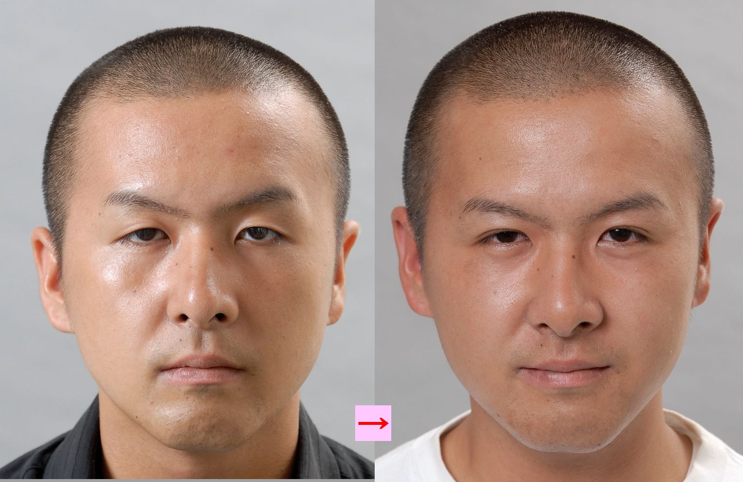 垂れ目を改善したい 画像あり 横浜で働く美容外科院長の美容整形ここだけの話ブログ