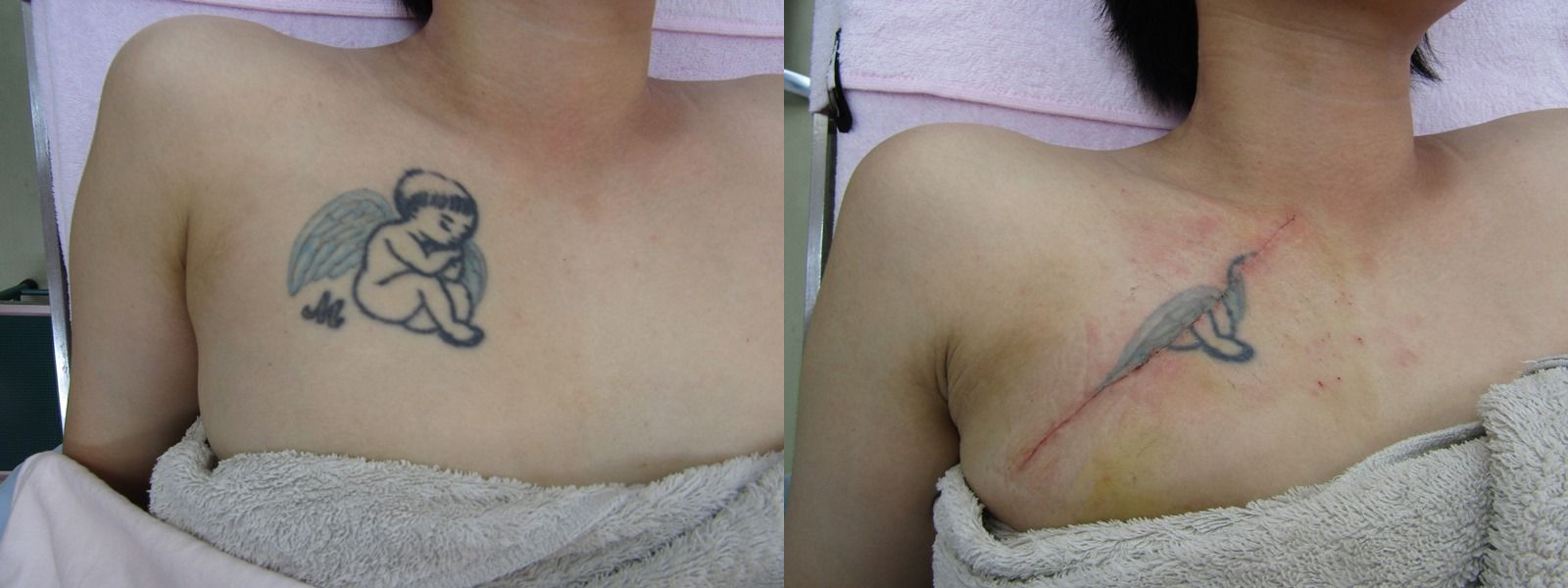 刺青を取りたい 胸 二の腕 画像あり 横浜で働く美容外科院長の美容整形ここだけの話ブログ