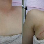 刺青を取りたい　胸、二の腕　（画像あり）