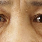 目の周りの若返りでお顔の印象を明るく　（画像あり）