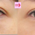 切らない目の下の脱脂術　４０代の場合　（画像あり）
