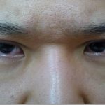 埋没法の術後の腫れが気になる　（画像あり）
