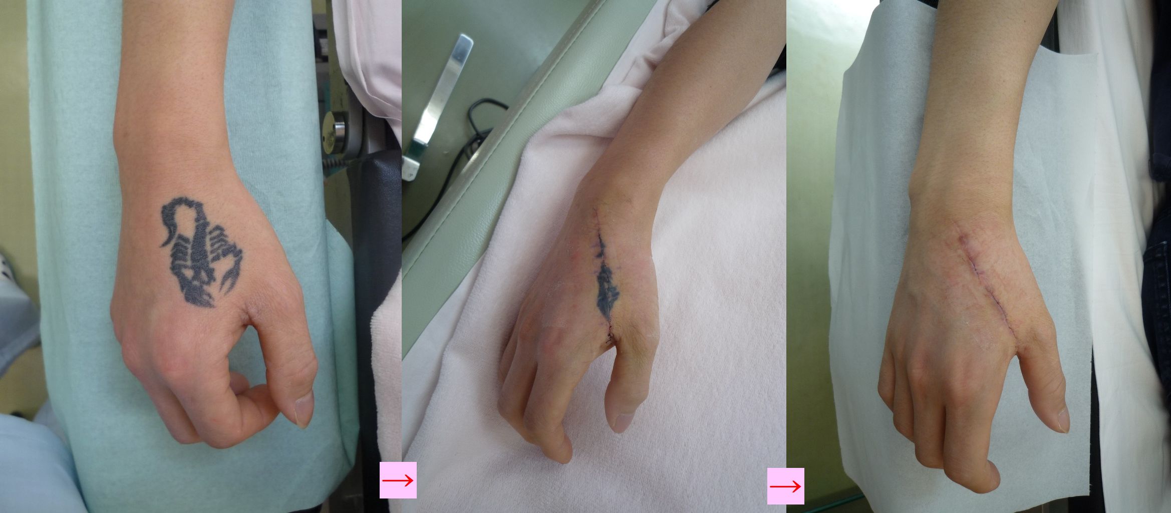 刺青を取りたい 手 画像あり 横浜で働く美容外科院長の美容整形ここだけの話ブログ 刺青を取りたい 手 画像あり 横浜で働く美容外科院長の美容整形ここだけの話ブログ