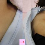 刺青を取りたい　レーザー治療後　（画像あり）
