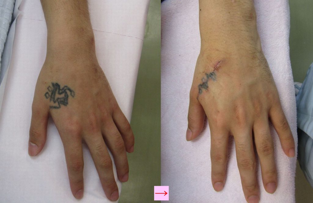 刺青を取りたい 手 画像あり 横浜で働く美容外科院長の美容整形ここだけの話ブログ