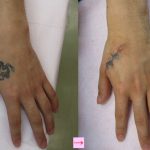 刺青を取りたい　手　（画像あり）
