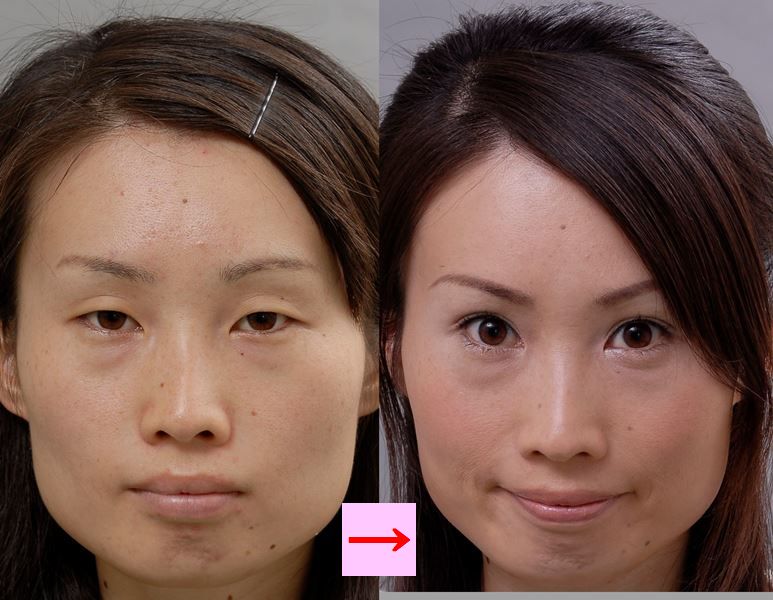 二重まぶたの手術による目元の印象の変化 画像あり 横浜で働く美容外科院長の美容整形ここだけの話ブログ