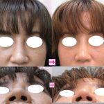 団子鼻を改善したい　（画像あり）