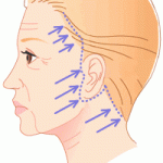 他院のフェイスリフト後の耳たぶの変形　治せます　（画像あり）